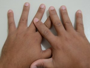 Sesau firma parceria para realizar Mutirões de Cirurgia da Mão