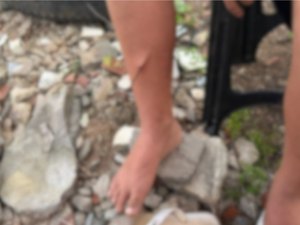 Criança de 10 anos é levada ao HEA após ter perna perfurada por vergalhão em Arapiraca
