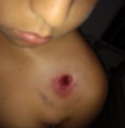 Após abordagem policial a usuários de drogas, menino de nove anos é atingido por bala de borracha