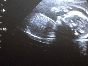 Brasil é único país do mundo a ter bebê gerado em útero transplantado de doadora morta
