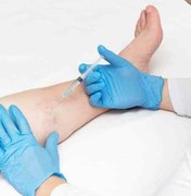 Saúde disponibiliza tratamento de microvasos e varizes no Pam Salgadinho