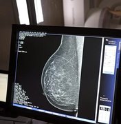 Cerca de 77 mil mulheres aguardam mamografia pelo SUS