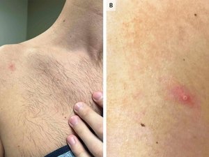 Com mais de 800 infectados, Brasil é o 7º país com maior número de casos de varíola do macaco