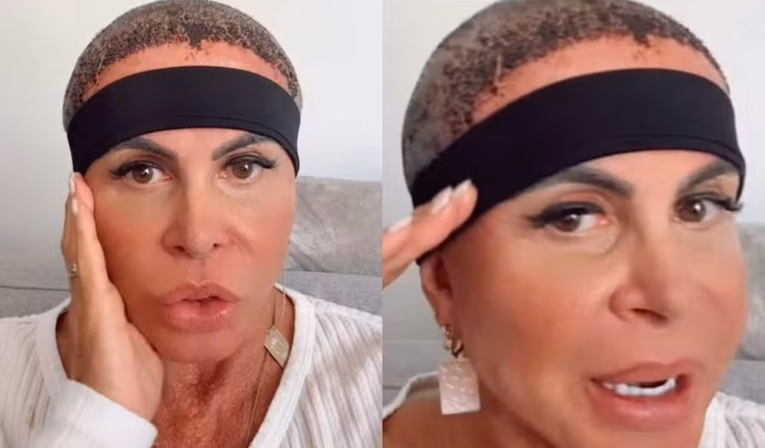 Gretchen compartilha diário e explica uso de faixa após transplante capilar