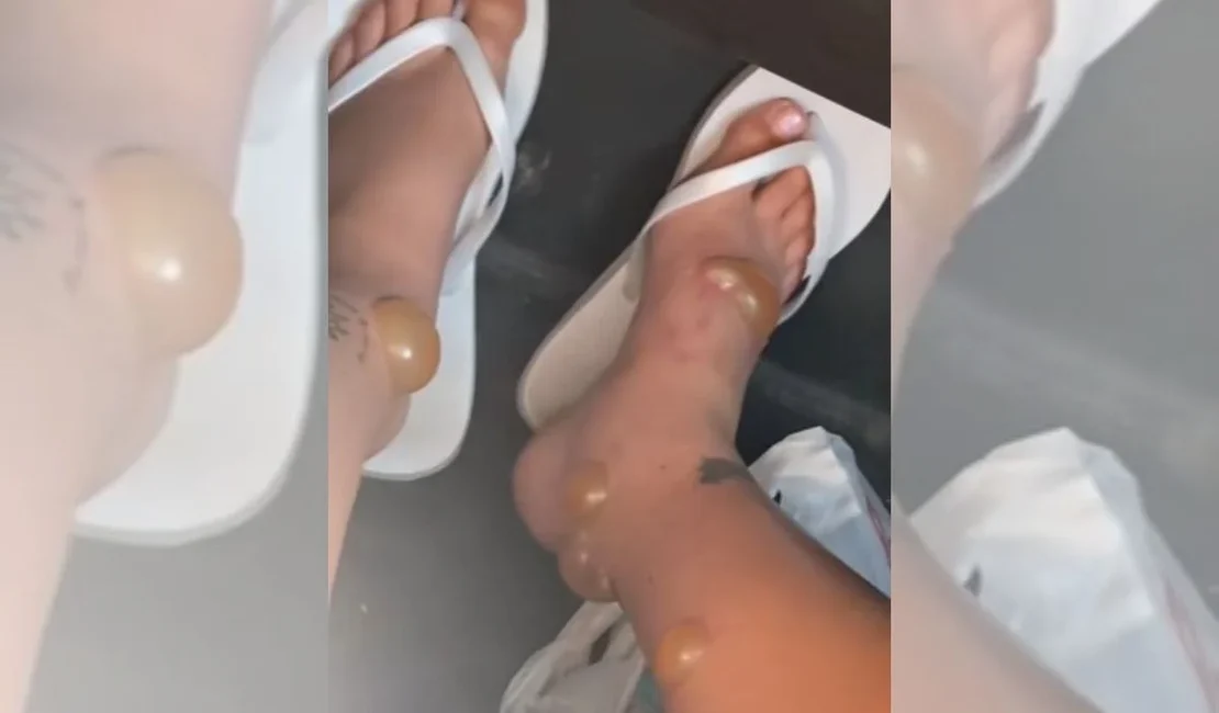 Lua de mel vira pesadelo após reação chocante a picadas de insetos