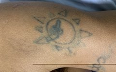 Tatuagens encontradas em paciente