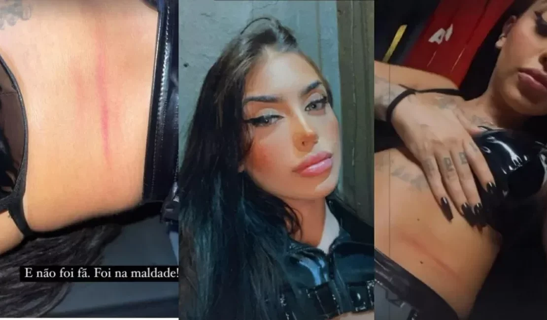 Mirella mostra marcas pelo corpo e desabafa: 'Não foi fã, foi na maldade'