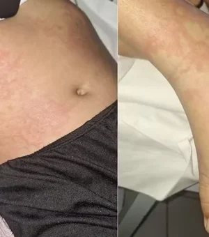 Menina de 10 anos luta contra infecção após contato com detergente Ypê
