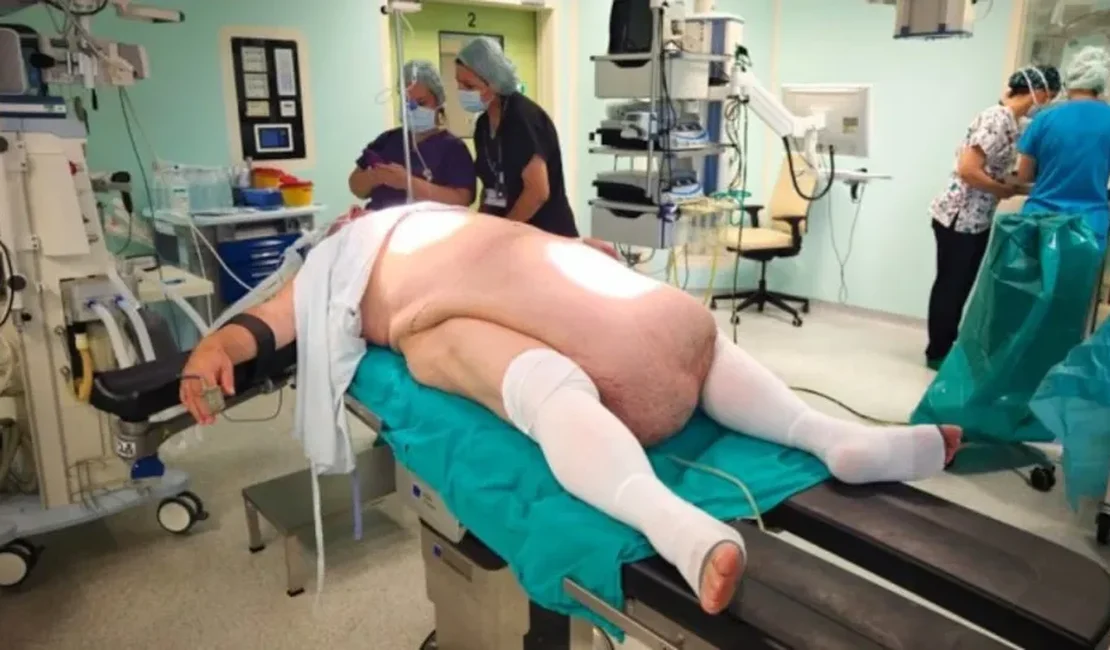 Tumor abdominal de 35 kg impede homem de urinar e choca médicos