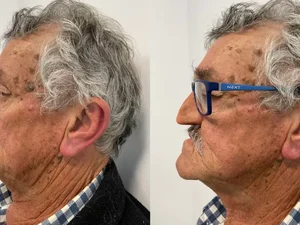 'Vivi 2 anos sem nariz, mas uma prótese facial ajudou a me reerguer'
