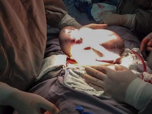 Bebê nasce dentro da bolsa amniótica durante parto raríssimo em SP