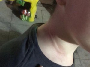 Crianças sofrem lesões por problemas no cinto de segurança  em carrinho “Bate-Bate” 