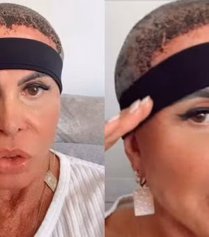 Gretchen compartilha diário e explica uso de faixa após transplante capilar