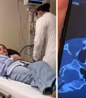 Juliette Freire fratura o nariz em acidente doméstico: 'Está meio torto'