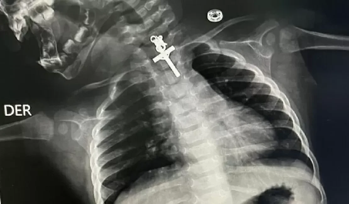 Bebê de 10 meses fica com crucifixo preso na garganta no Peru