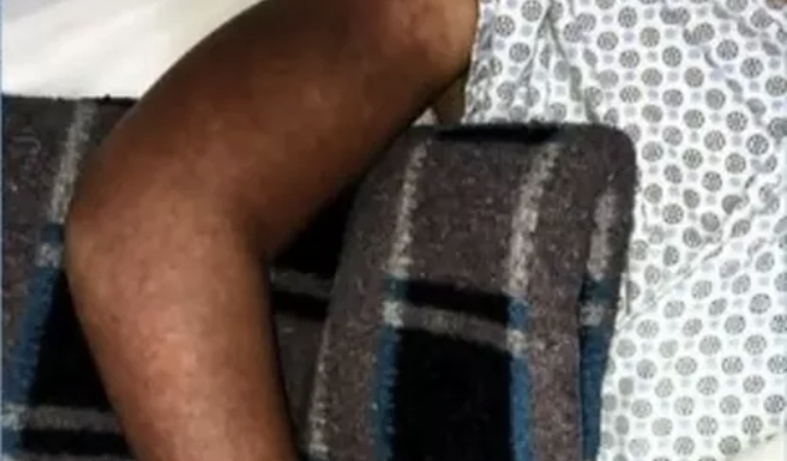 Criança de 10 anos tem braço sugado por ralo de piscina em Maceió