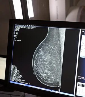 Cerca de 77 mil mulheres aguardam mamografia pelo SUS