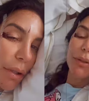 Ivete Sangalo surge em hospital com machucados no rosto e relata susto: 'Desmaiei'