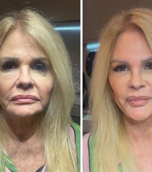 Monique Evans festeja resultado de harmonização facial: 'Ele fez milagre'