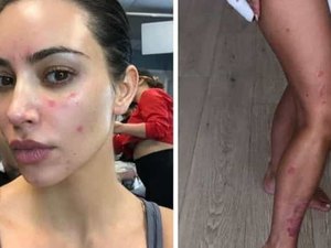 Kim Kardashian revela fotos que mostram marcas da psoríase