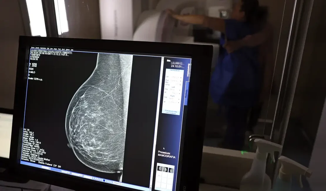 Ministério da Saúde passa a recomendar mamografia a partir dos 40 anos