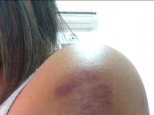 Polícia Civil investiga caso do vereador acusado de espancar ex-namorada