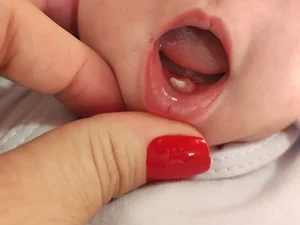 Bebê surpreende ao nascer com ‘dentinho’ e intriga pais no interior de SP; Especialista explica condição