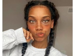 Modelo gasta R$ 39 mil em cirurgia para reduzir 3 cm de testa