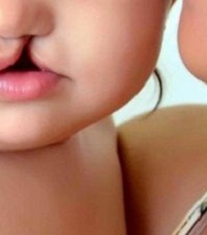 Atendimento gratuito a crianças com deformidade no lábio vai até o dia 19