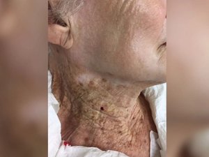 Estudo analisa pele de idosa que, por 40 anos, usou filtro solar só no rosto