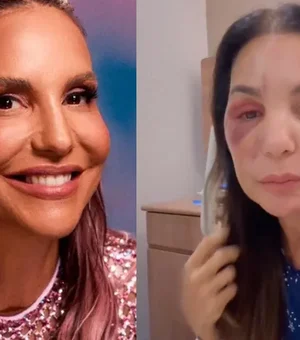 Ivete Sangalo mostra rosto com hematoma e esclarece estado de saúde