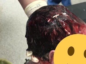 Bebê nasce com DIU preso no cabelo. Médico explica o caso