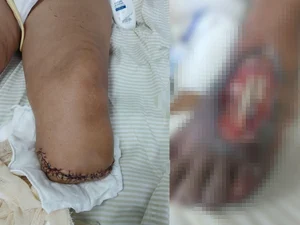 Idosa que corria risco de perder o pé após suposta negligência médica tem parte da perna amputada