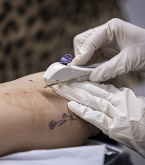 Em dois meses, Implanon é disponibilizado para mais de 600 mulheres