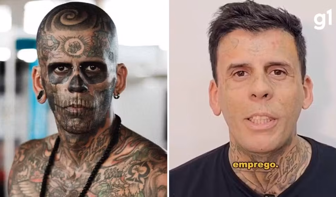 'Mais tatuado do Brasil' surge irreconhecível após passar por nova sessão de remoção de tatuagens no rosto