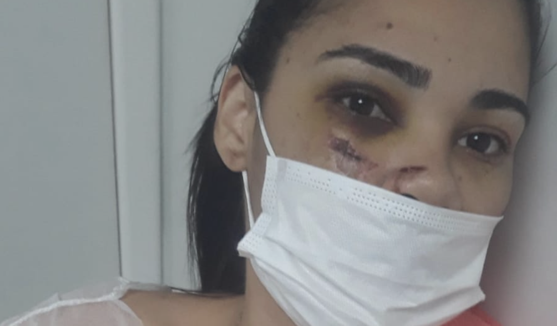 Arapiraquense demitida após queda de moto faz rifa para recuperar dentes que quebraram no acidente