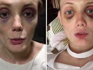 Modelo mostra hematomas e denuncia agressões de ex-namorado nas redes sociais