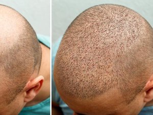 Homem morre após passar mal em clínica de transplante capilar na Turquia