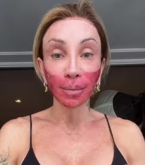 Com o rosto vermelho após novo peeling, Maya Massafera rebate críticas