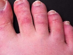 Novo Sintoma: 'Dedos de covid' podem durar até 150 dias em pacientes, mostra estudo