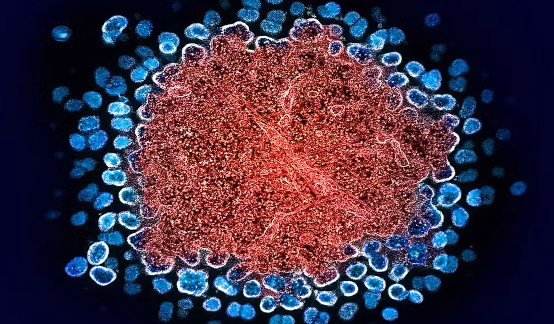 Homem tem remissão do HIV após transplante inédito de medula óssea do irmão