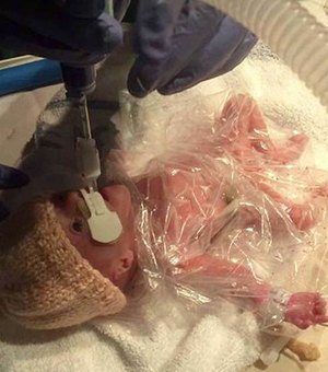 Bebê prematura e com 560 gramas é salva por saco plástico de sanduíche