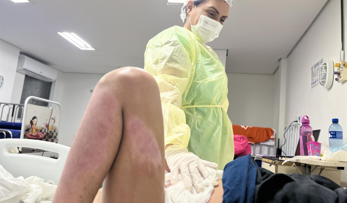 HGE alerta para os riscos causados por queimaduras e recomenda atenção também dentro de casa