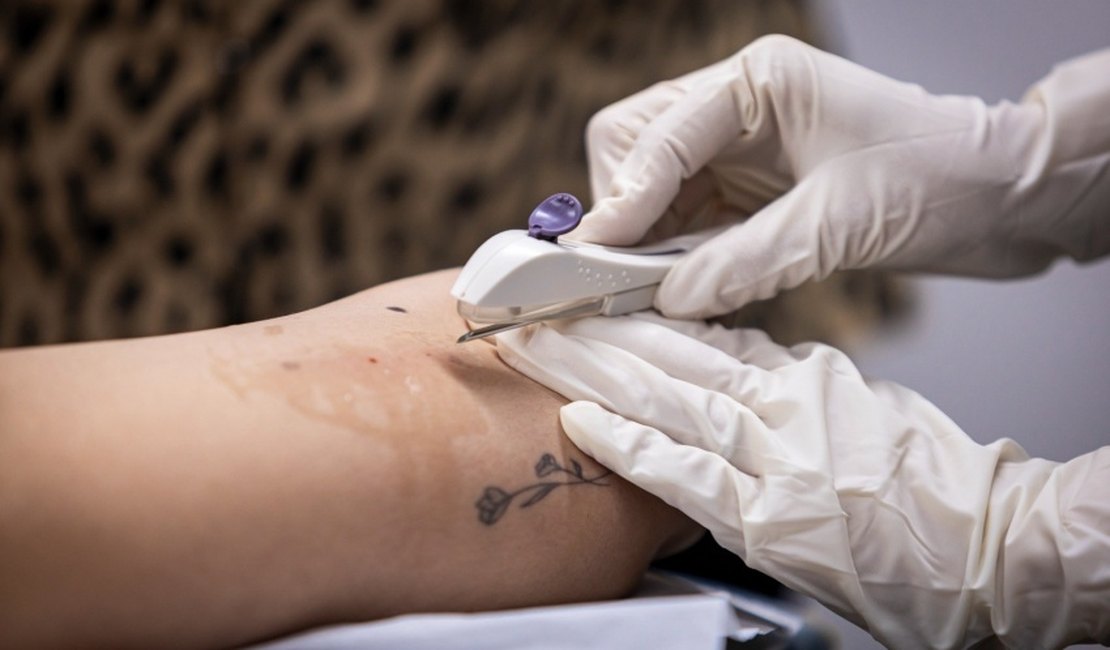 Saúde em Maceió disponibiliza inserção gratuita do Implanon