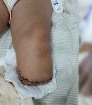 Idosa que corria risco de perder o pé após suposta negligência médica tem parte da perna amputada