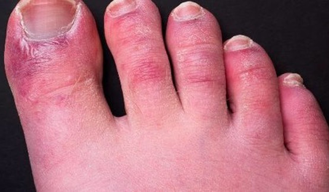 Novo Sintoma: 'Dedos de covid' podem durar até 150 dias em pacientes, mostra estudo