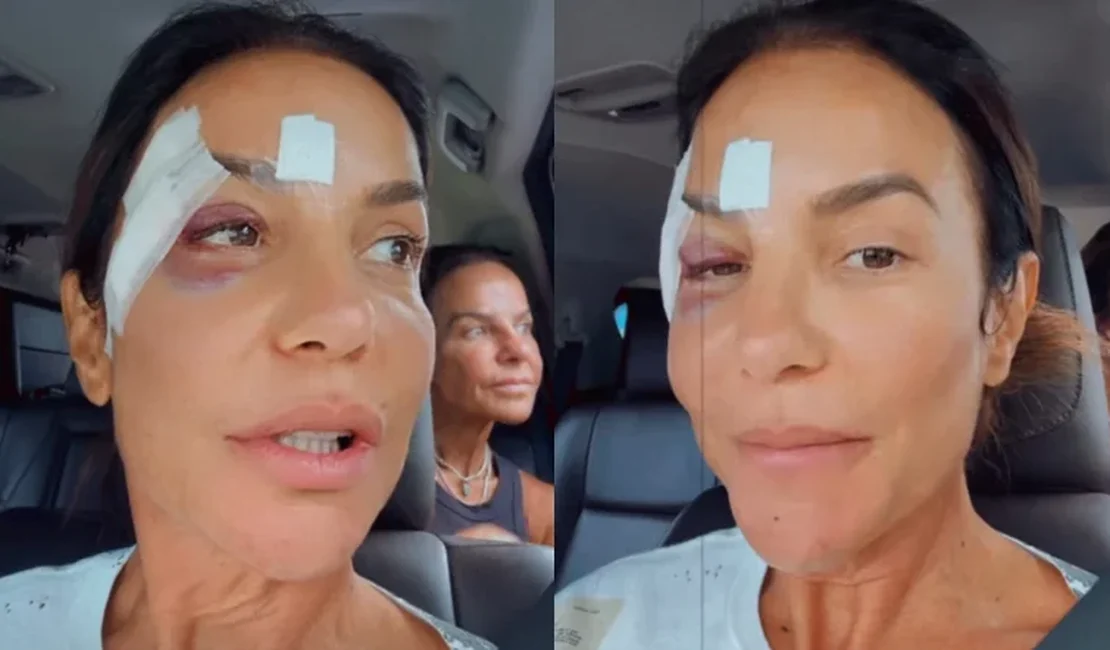 Ivete Sangalo faz cirurgia no maxilar após queda em casa; saiba como está a cantora