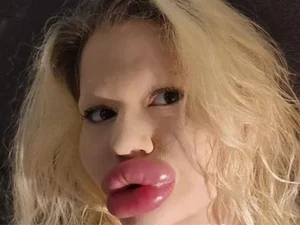 Dentistas se recusam a atender “mulher com maiores lábios do mundo”