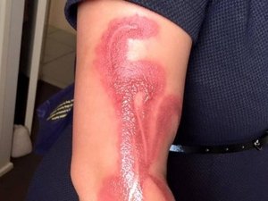 Mulher tem braço queimado após dormir sobre iPhone 7