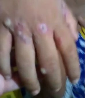 Médicos descartam caso de varíola em criança de Arapiraca que teve vídeo nas redes sociais viralizado